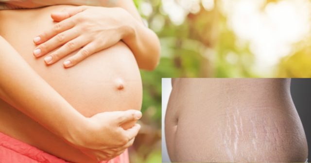 Растяжек не будет! Как ухаживать за кожей во время беременности