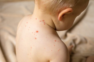 chickenpox-vaccine-feature